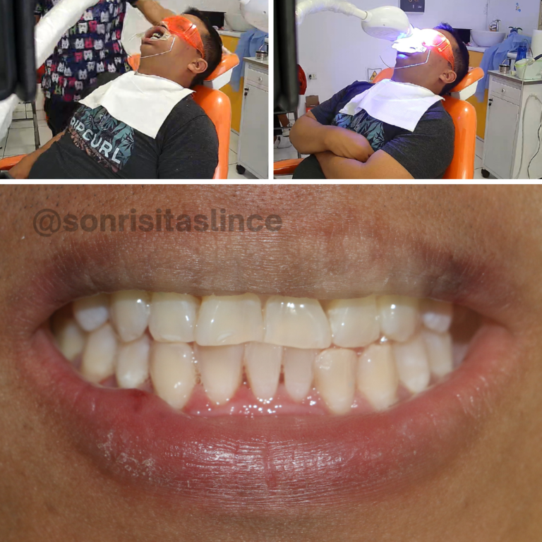 ¡Nuestro paciente se realizó un blanqueamiento dental y un destartraje con nosotros!