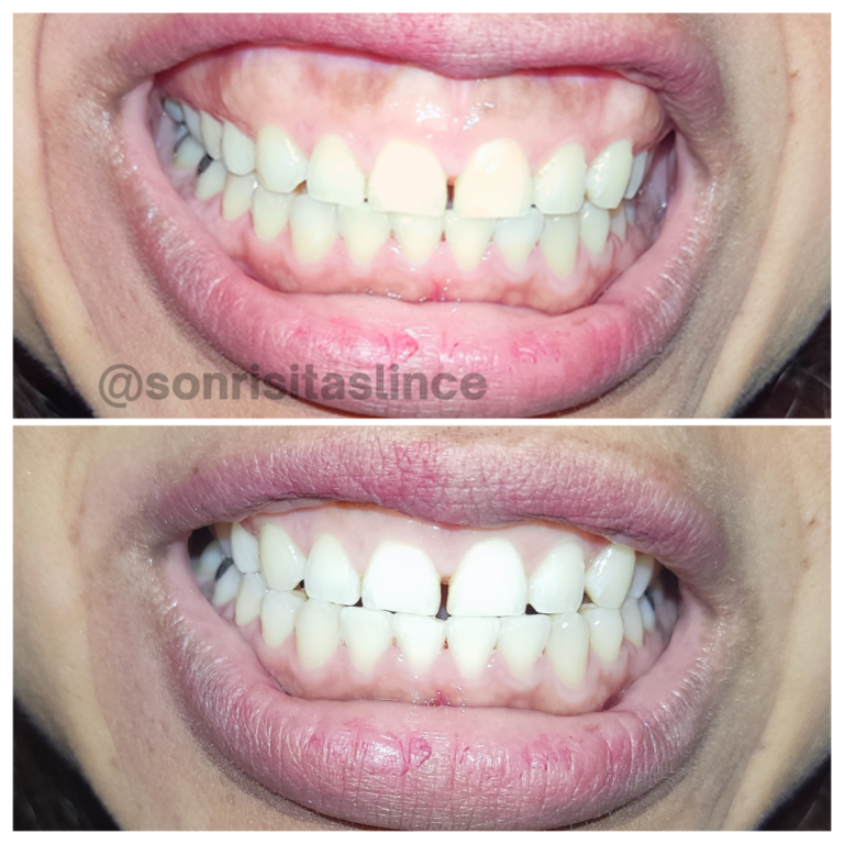 Nuestra paciente se hizo una sola sesión de blanquemiento dental y quedó con una sonrisa más brillante, utilizamos la técnica LED.