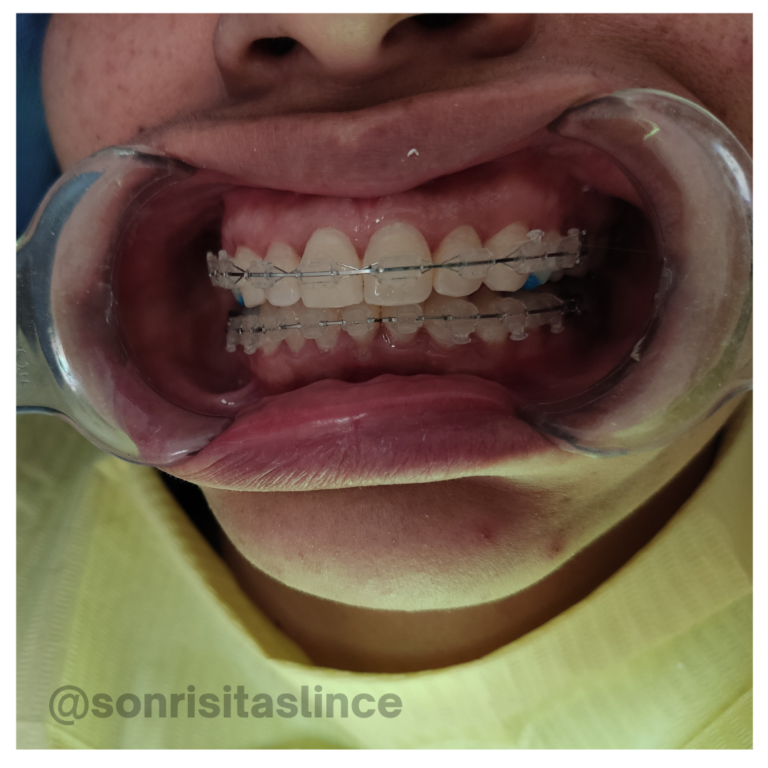 paciente dentista brackets zafiro