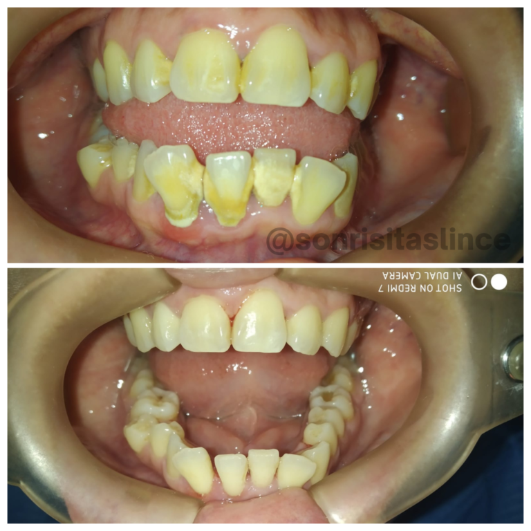 Aquí podemos apreciar un destartraje en grado C. Esto es generado por un deficit de la higiene bucal. En nuestra clínica dental tratamos destartrajes en todos los grados (a, b y c).🦷✨🤗