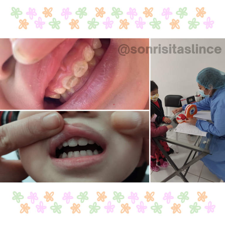 Nuestra paciente vino con un caso de CARIES DE BIBERÓN, se le realizaron unas coronas de resina y se le brindó pedagogía sobre el cepillado dental.