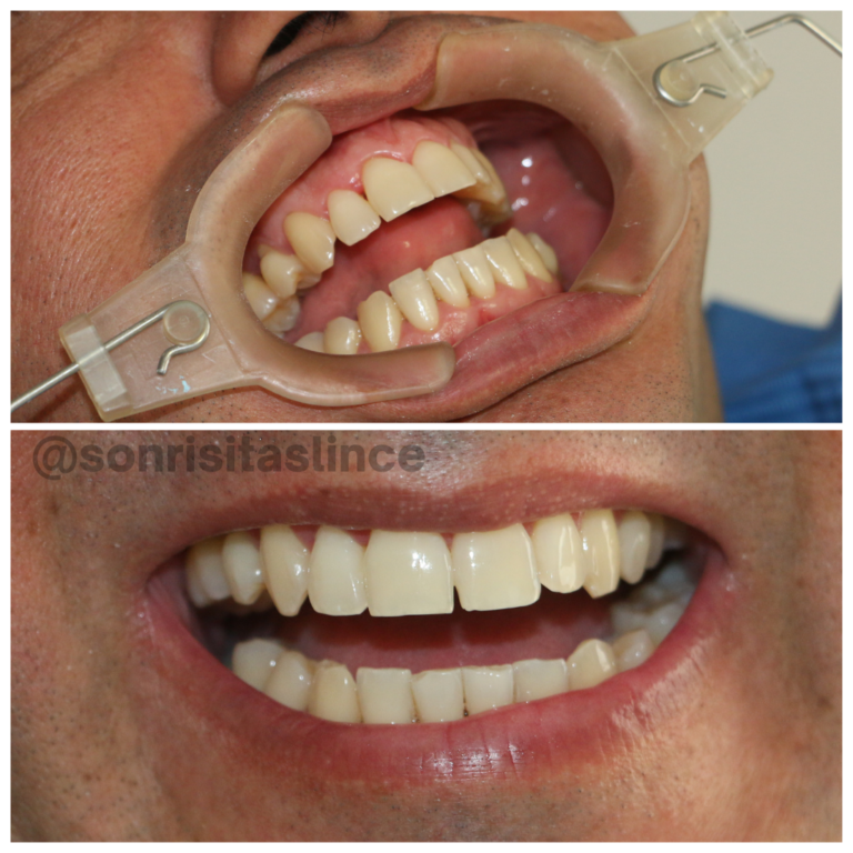 paciente blanqueamiento dental