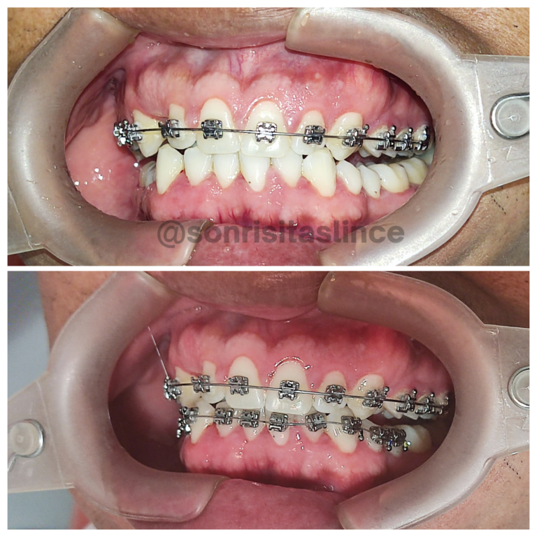 paciente brackets autoligables