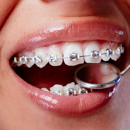 Brackets - Sonristas y Sonrisitas Lince